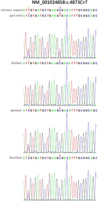 Preliminary Study on the Clinical and Genetic Characteristics of Hereditary Spherocytosis in 15 Chinese Children